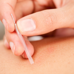dry_needling
